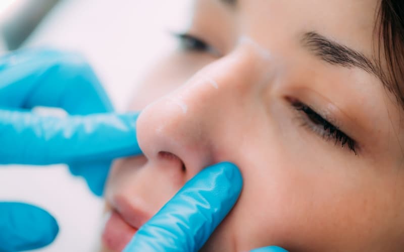 A clinician in blue gloves administering a dermal filler injection beside a patient's mouth