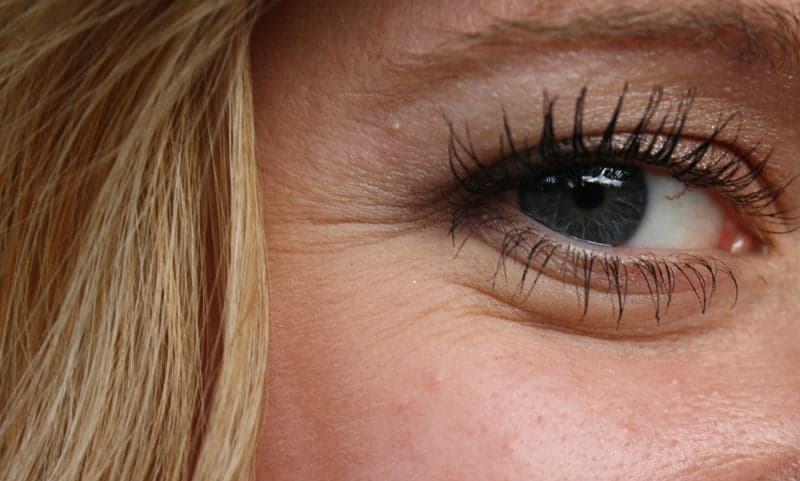 A close-up of fine lines around a patient's eye before treatment