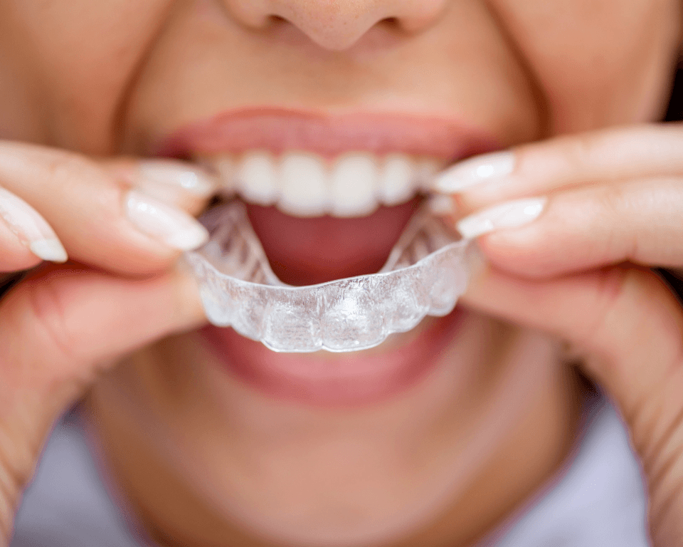 A patient fitting a clear aligner over their upper teeth