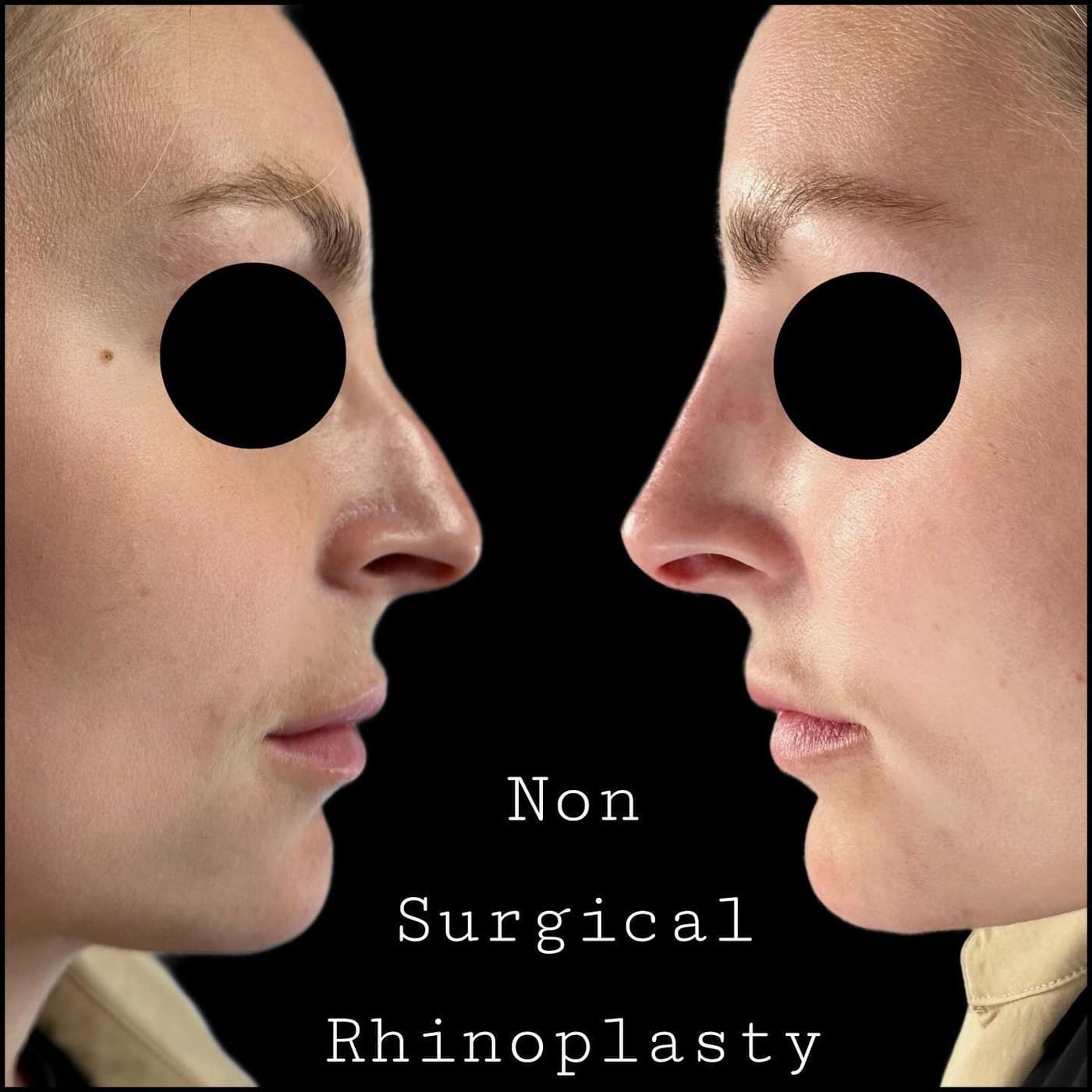Non-surgical rhinoplasty, before and after side profiles with the eyes masked: the tip is lifted and the bridge line evened