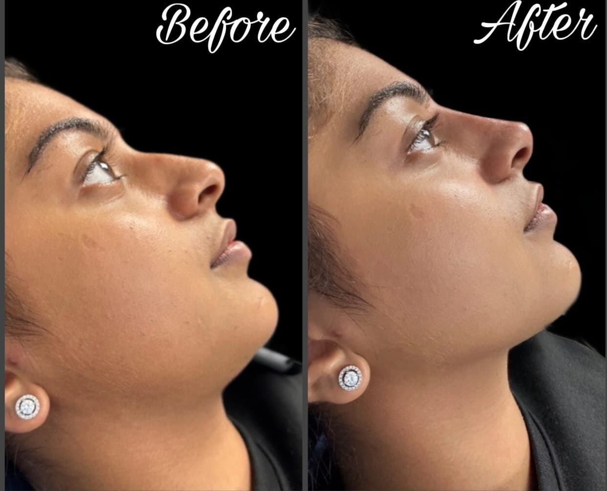 Non-surgical rhinoplasty, before and after side profiles looking upward: the tip is lifted and the bridge straightened