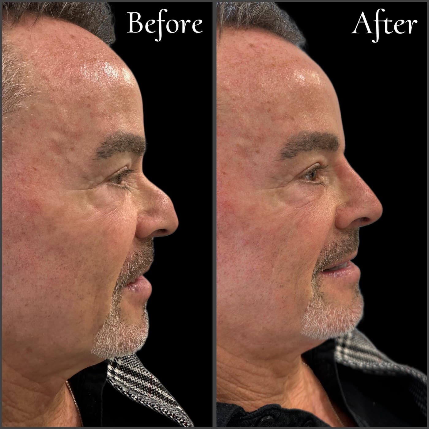 Non-surgical rhinoplasty on an older man, before and after side profiles: the dip in the bridge filled and the tip supported
