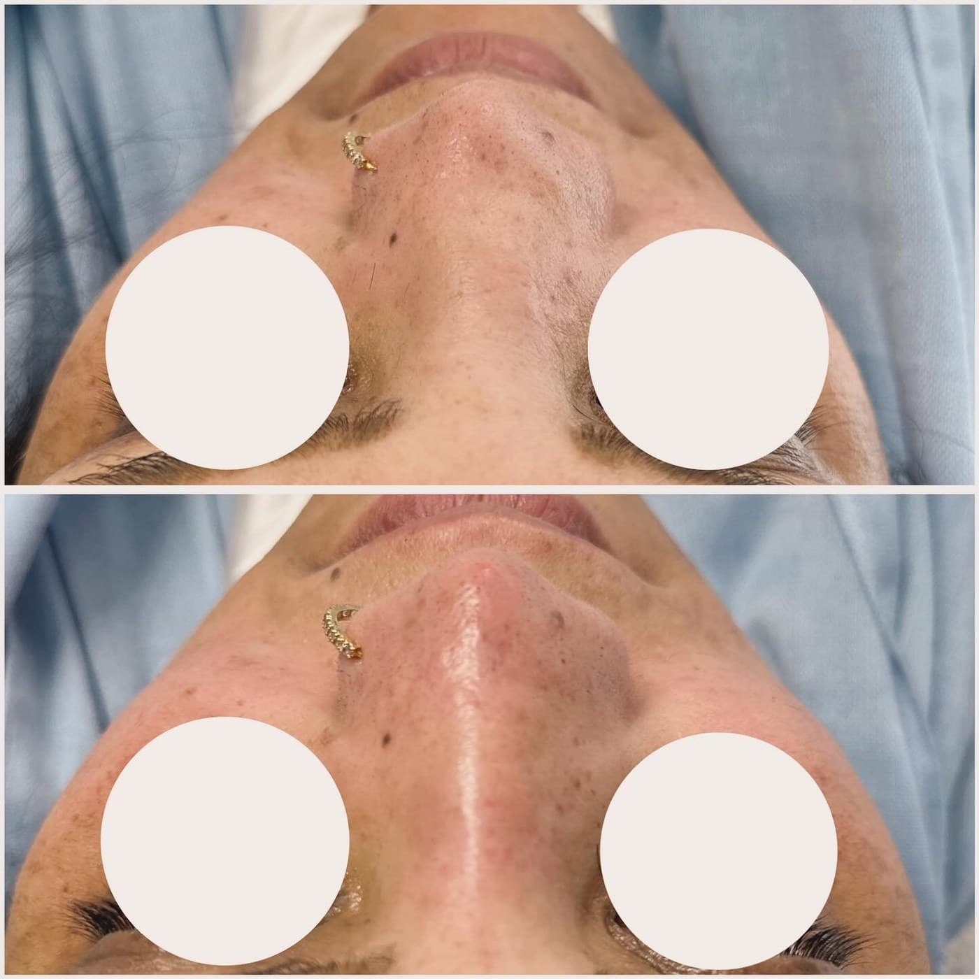Non-surgical rhinoplasty seen from below, before and after, eyes masked: the nasal bridge is straighter and more even